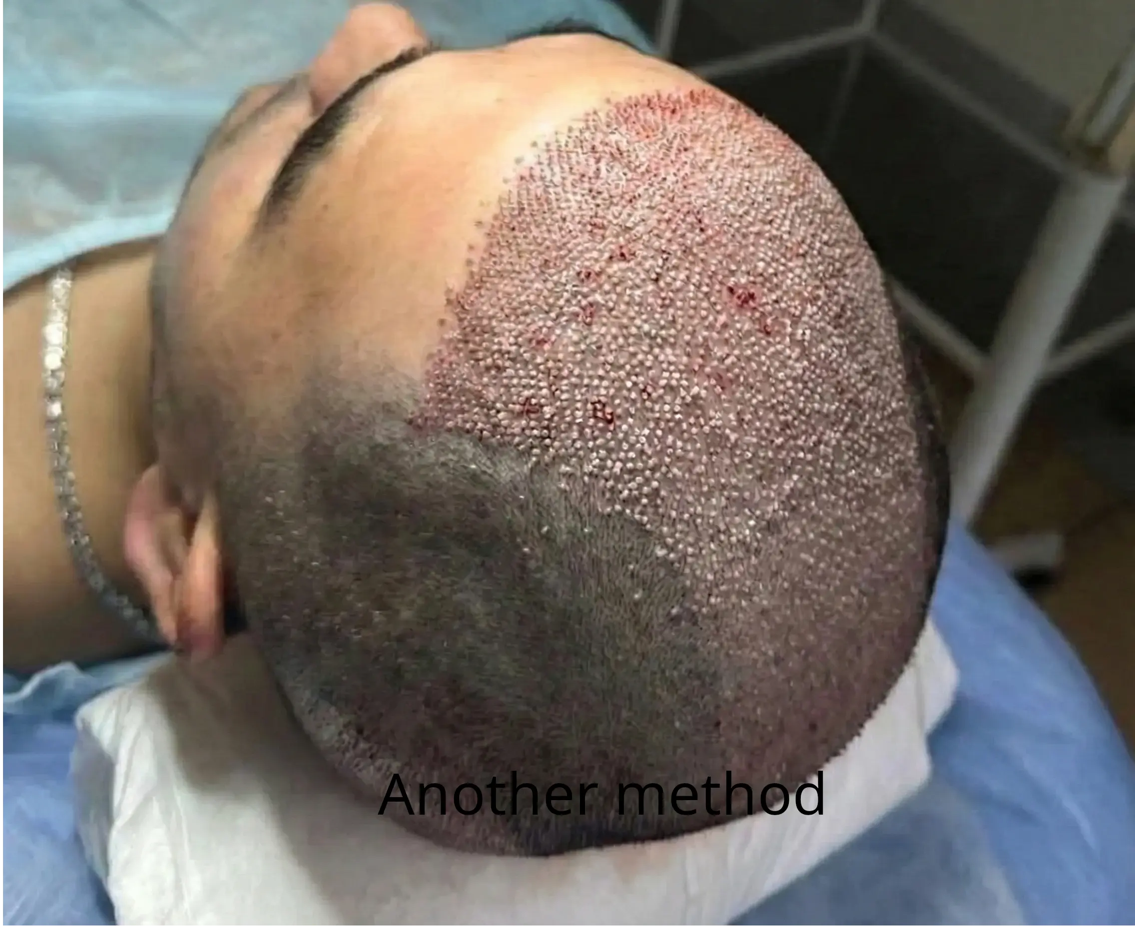 Unnatural hair growth direction from traditional transplantation